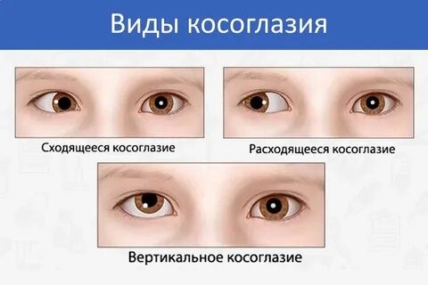 виды косоглазия.jpg виды косоглазия.jpg