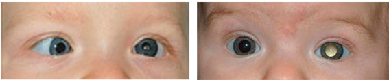 retinobl1.jpg Ретинобластома