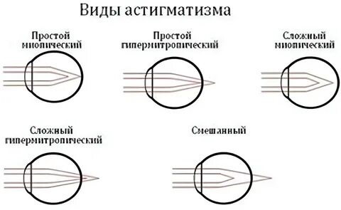 астигматизм у детей.jpg Астигматизм у детей