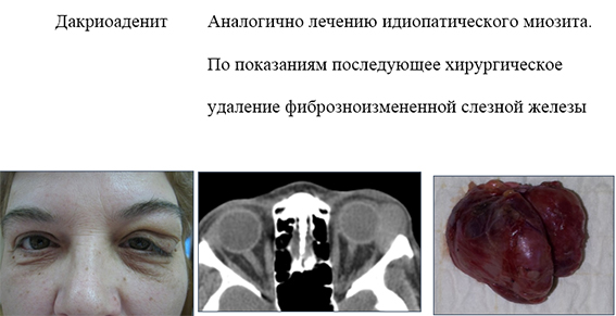 dio.jpg Дакриоаденит