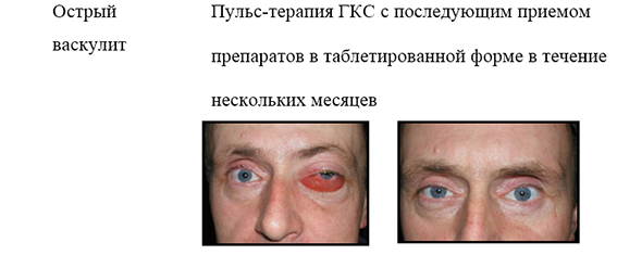 ostr-v.jpg Пульс-терапия