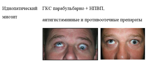 miozit.jpg Идиопатический миозит